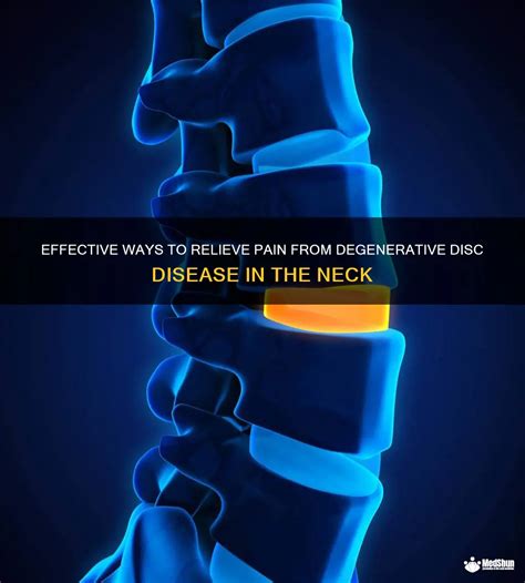 Effective Ways To Relieve Pain From Degenerative Disc Disease In The Neck Medshun