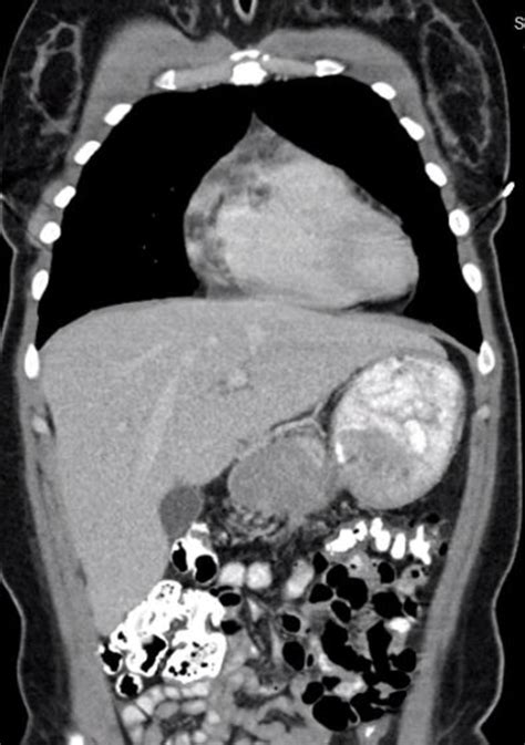 Computed Tomography Chest Abdomen Pelvis Findings With Iv And Oral