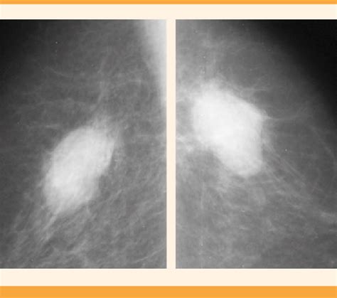 Mastograf A Bilateral En Ambas Mamas Se Observan N Dulos Ovalados