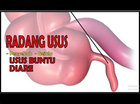 Gejala Dan Penyebab Usus Buntu Dan Diare Youtube