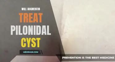 A Step By Step Guide On How To Properly Soak A Pilonidal Cyst Medshun