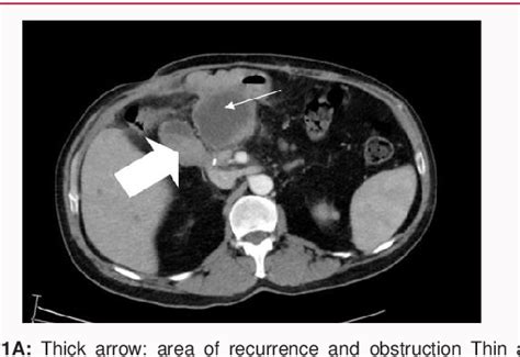 Figure 1 From Endoscopic Ultrasound Guided Gastrojejunostomy Stent