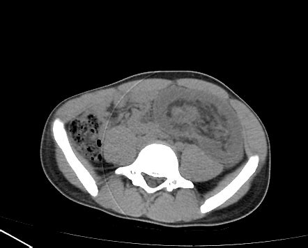 Colocolic Intussusception Due To Leading Point Lipoma In The Rectum