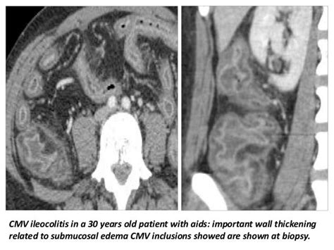 Presentation1 Radiological Imaging Of Colitis