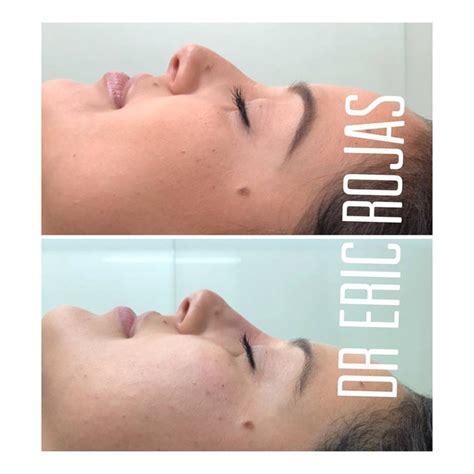 Rinolift corrección de perfil Dr Eric Rojas Dermatología Laser