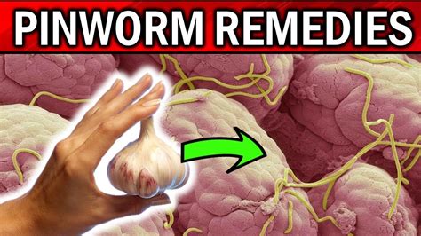 Pinworms | 8 EFFECTIVE Home Remedies for PINWORMS | Threadworms ...