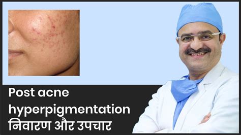 Post Acne Hyperpigmentation निवारण और उपचारprevention And Treatments