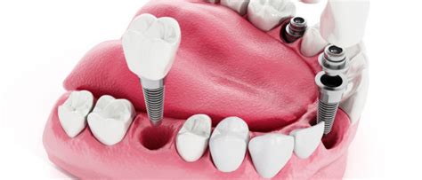 Dentsply Implants | Comparethetreatment.com