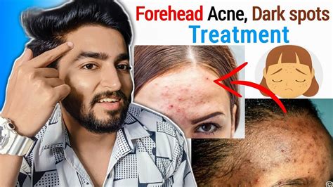 Forehead Acne Pimples Blackheads And Darkspots Treatment Youtube