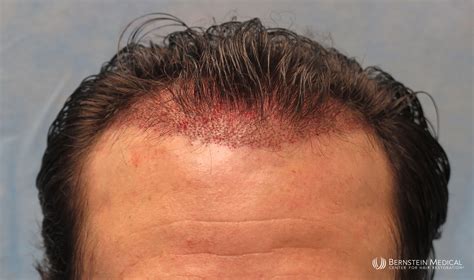 Patient Kjc Bernstein Medical Center For Hair Restoration