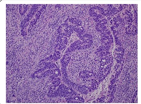 Well Differentiated Adenocarcinoma Of The Rectum × 200 Download