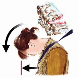 explaining spinal disorders neck sprains whiplash  strains