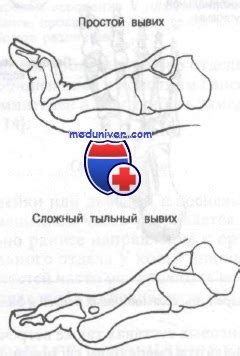 вывих мизинца на ноге что делать