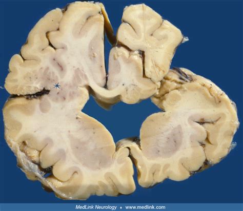 Schizencephaly Medlink Neurology