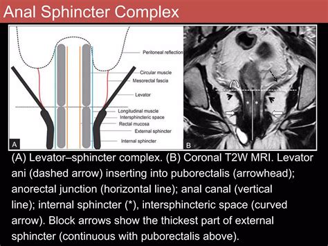 Role Of Mri In Rectal Carcinoma PPT