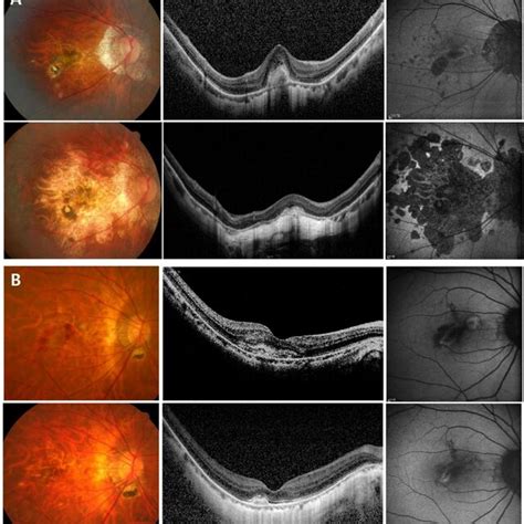 Color Fundus Photo Optical Coherence Tomography And Fundus