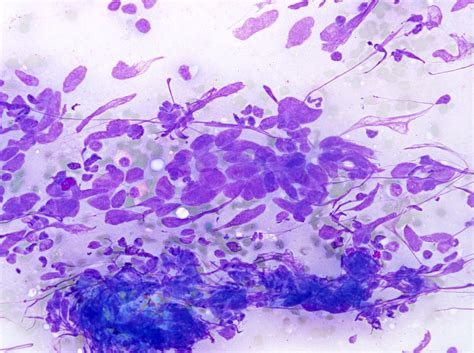 Pathology Outlines Nasopharyngeal Carcinoma