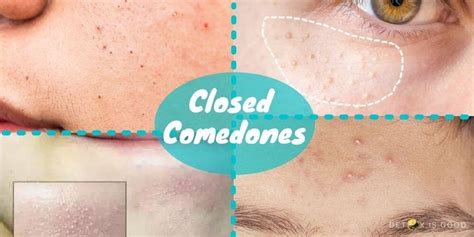 How To Get Rid Of Closed Comedones Natural Remedies