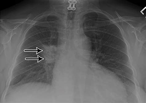 Recognizing Radiation Therapyrelated Complications In The Chest