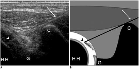 Ultrasonography Guided Rotator Interval Injection Technique For Download Scientific Diagram