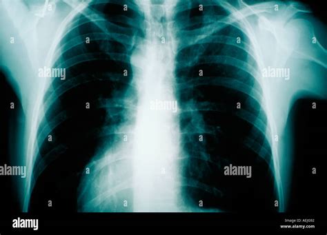 X ray of human chest Stock Photo - Alamy