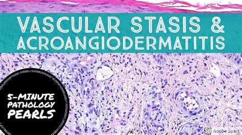 Pseudo Kaposi Sarcoma Acroangiodermatitis Aka Severe Stasis 5 Minute