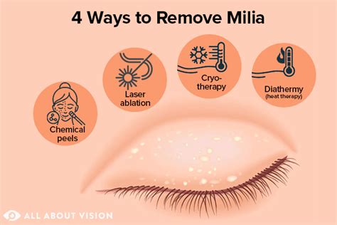 Eyelid Bumps 101 How To Identify Styes Milia Pimples 48 Off