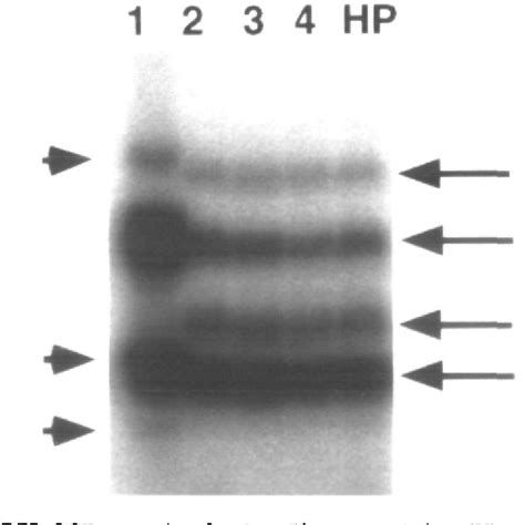 Chromosome 9p Deletion Syndrome Semantic Scholar