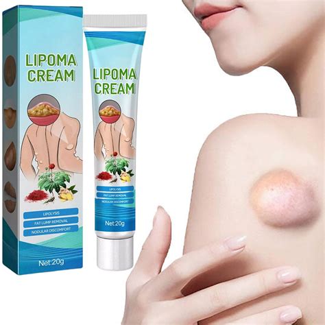 Buy Longluan Lumpfree Lipoma Removal Cream Al Lipoma Lumps Removal