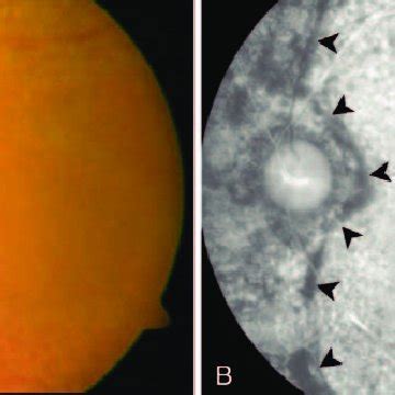 Fundus Photography And Fluorescein Angiography Of Case A Fundus