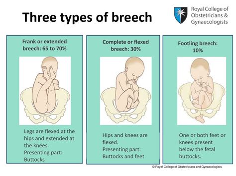 Ppt Breech Presentation Powerpoint Presentation Free Download Id