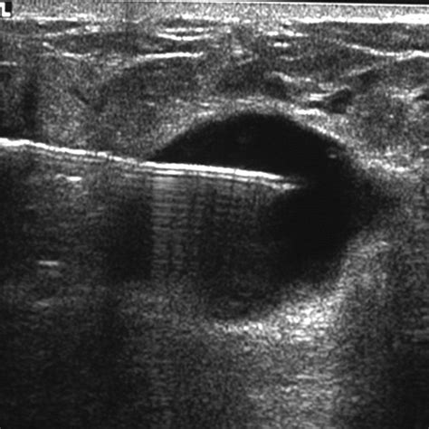 Complex Cystic Breast Masses Diagnostic Approach And Imaging