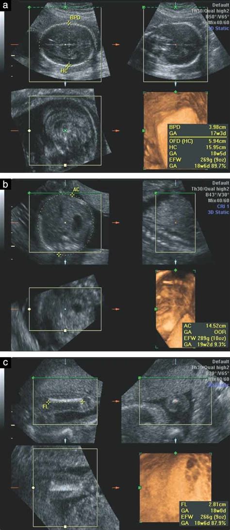 Fetal Biometry By An Inexperienced Operator Using Two And Three