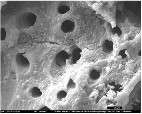 SEM of infected dentinal tubules. | Download Scientific Diagram