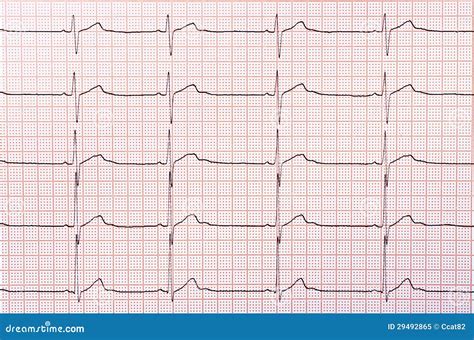 Heart Rhythm Identification Chart