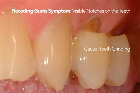 Receding Gums Causes Symptoms Treatment Options