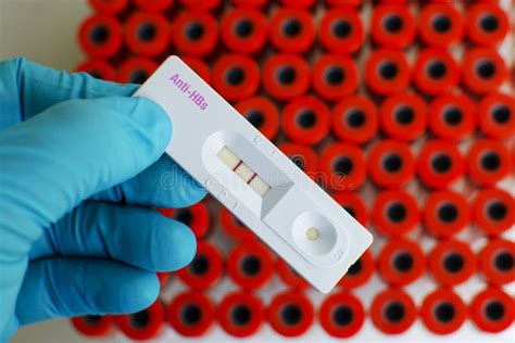 Hepatitis B Antibody Positive Stock Photo Image Of Experiment