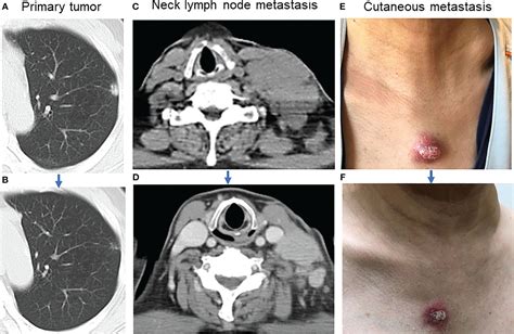 Frontiers Challenges In The Treatment Of BRAF K601E Mutated Lung