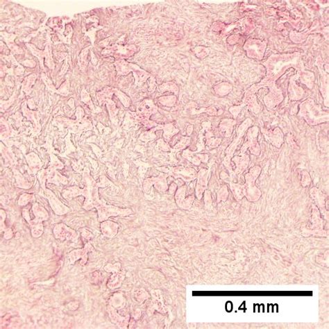 Cholangiocarcinoma Libre Pathology