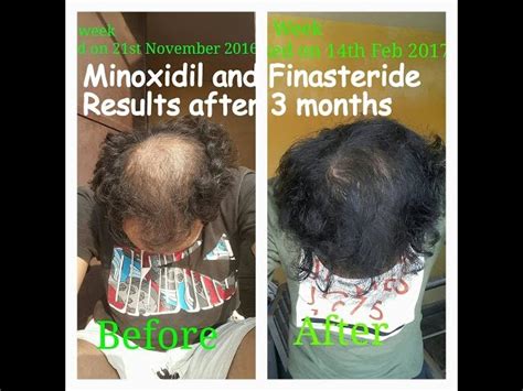 Finasteride Results 3 Months