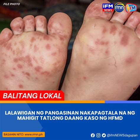 LALAWIGAN NG PANGASINAN NAKAPAGTALA NA NG MAHIGIT TATLONG DAANG KASO