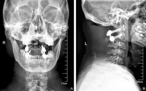 The Postoperative Anteroposterior A And Lateral B Radiographs