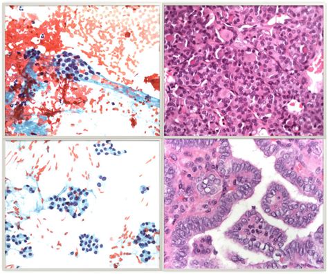 Two Cases Of Thyroid Nodules Cytologically Classified As Indeterminate