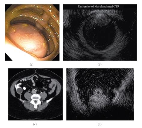 Endoscopic EUS And Radiographic Images Of Appendiceal Findings A