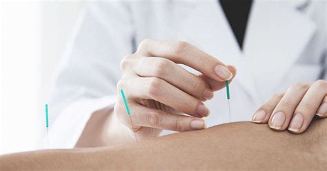 Dry Needling vs Acupuncture: Benefits and Risks