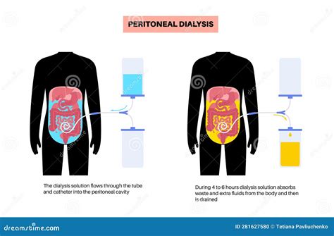 Abdominal Paracentesis Poster Vector Illustration