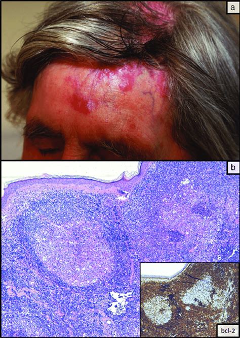 64 Year Old Patient Asymptomatic Coalescing Erythematous Plaques On Download Scientific