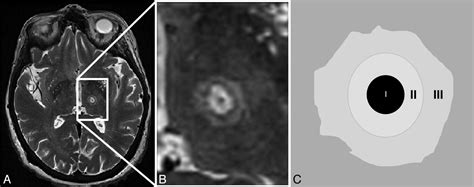 Imaging Findings In Mr Imagingguided Focused Ultrasound Treatment For