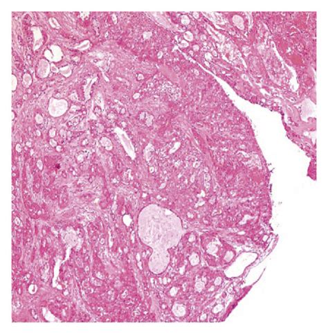 A 22 Year Old Woman With Low Grade Mucoepidermoid Carcinoma A Download Scientific Diagram