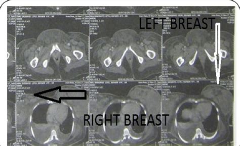 Vertical White Arrow Demonstrates Tumoral Involvement In Left Breast By